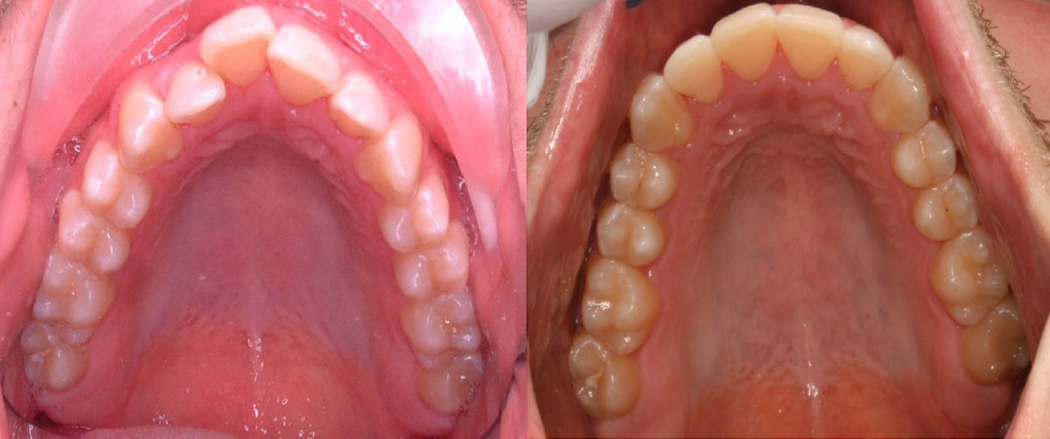 Invisalign, Invisalign Teen King Orthodontics Pittsburgh